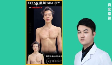 Dr·沈亚鑫院长 溜肩→直角肩案例