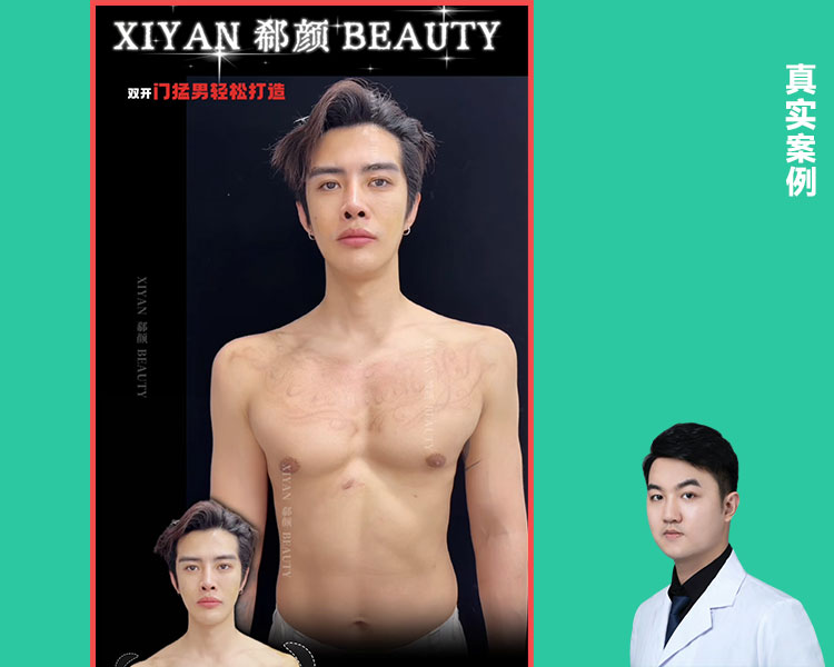 Dr·沈亚鑫院长 溜肩→直角肩案例